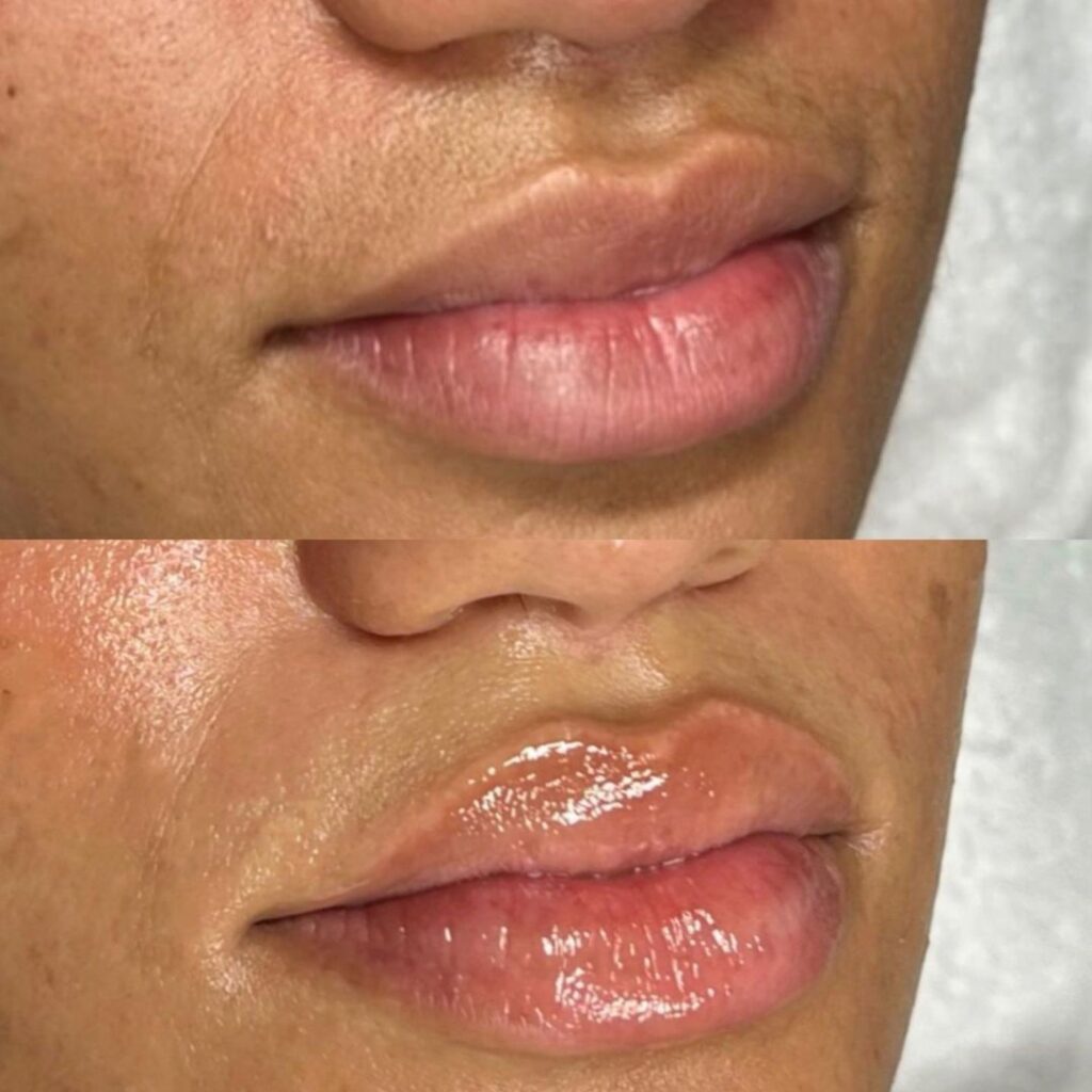 Hydrafacial behandelingen bij Soline Skin & More